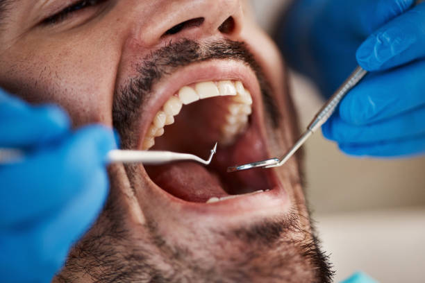 Best Emergency Wisdom Teeth Removal in Kimberly, WI