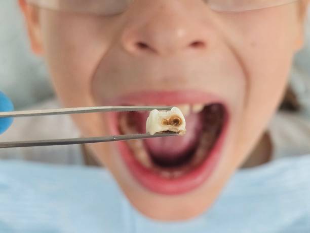 Best Emergency Treatment for Dental Infections or Abscesses in Kimberly, WI